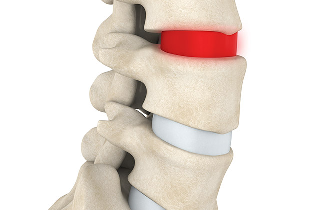 Assessing a spinal bulging disc