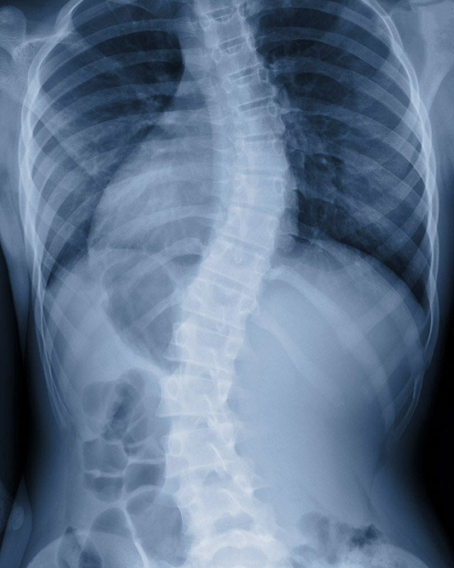 Assistance in treatment of scoliosis